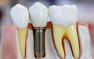 Benefits of Implant Anchored Dentures vs. Traditional Dentures