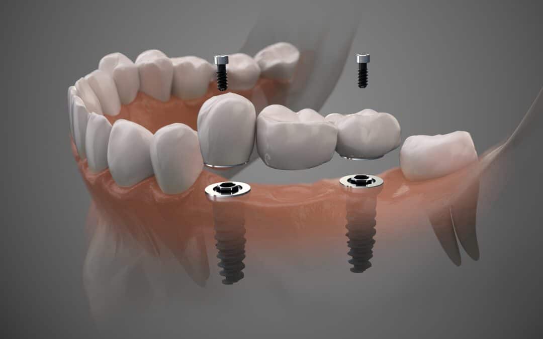 simulation photo of teeth showing implantation